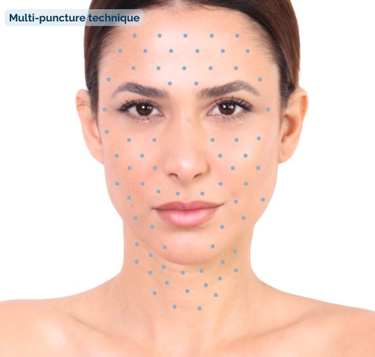 Macdermol® Biorevitalisation